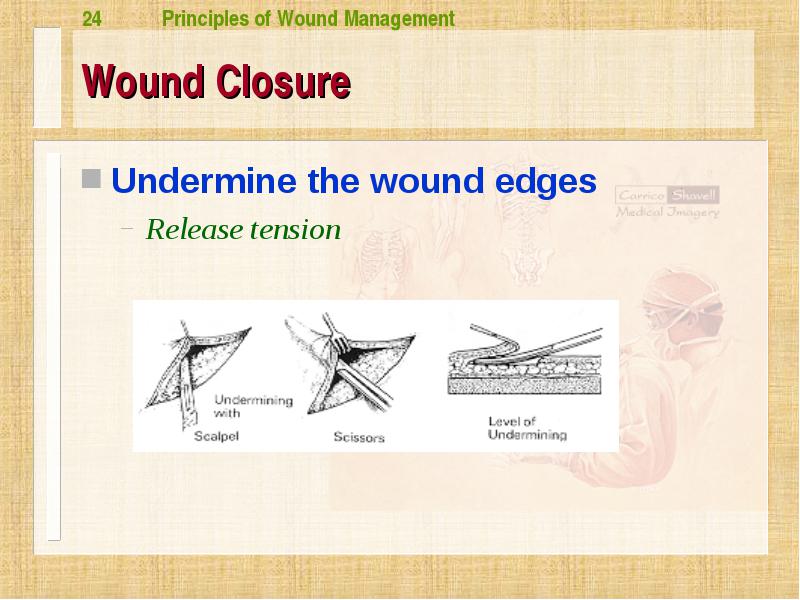 Wound Undermining at Stanley Shirlene blog